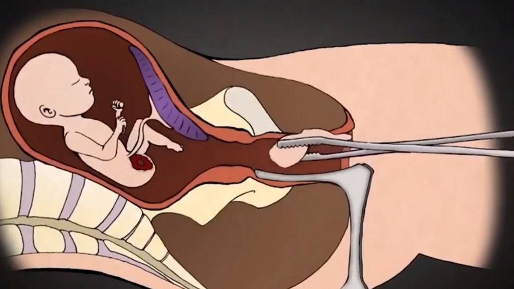 ''Aborcja bez granic'' sprzeczna z przepisami — Ordo Iuris