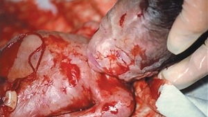 Aborcja nie chroni, aborcja zabija