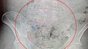 Miał w brzuchu prawie 300 tys. zł.! Grozi mu 20 lat więzienia!